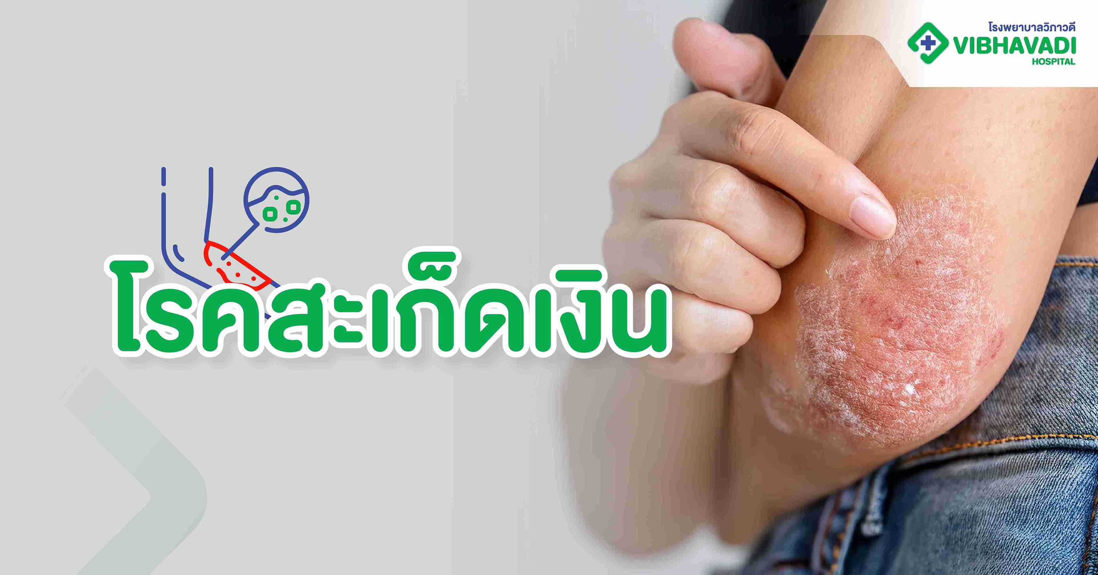 โรคสะเก็ดเงิน