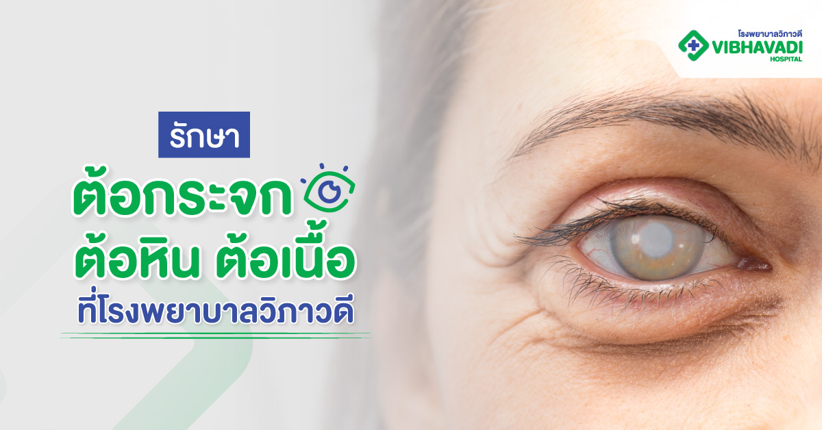 รักษาต้อกระจก ต้อหิน ต้อเนื้อ
