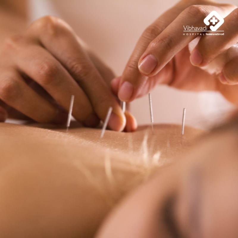 Things to Know Before Acupuncture