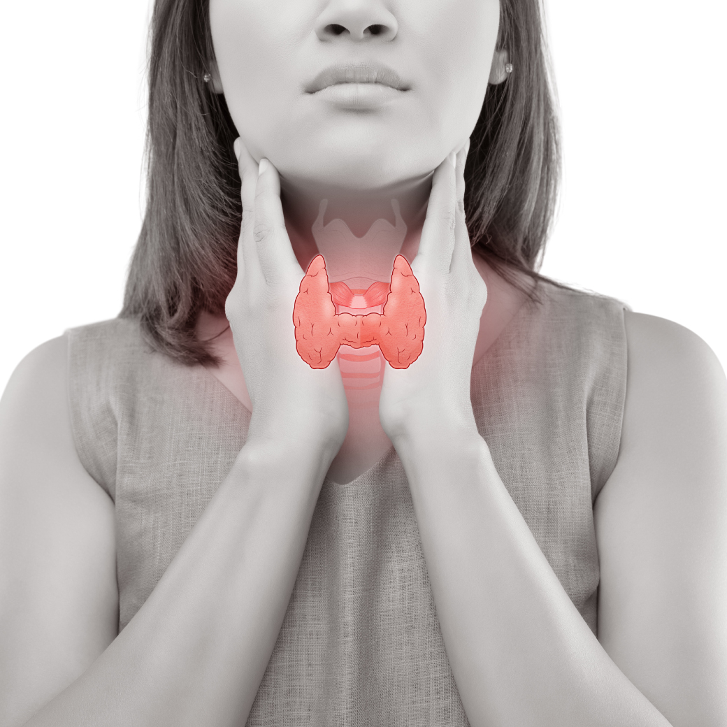 Goiter, an enlargement of the thyroid gland