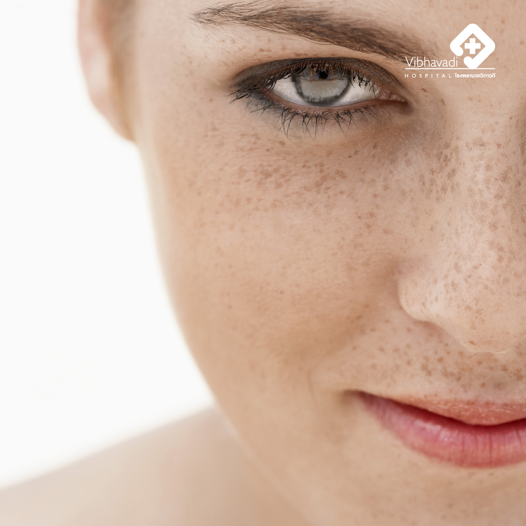 Dark Skin Spots from Melasma and Freckles