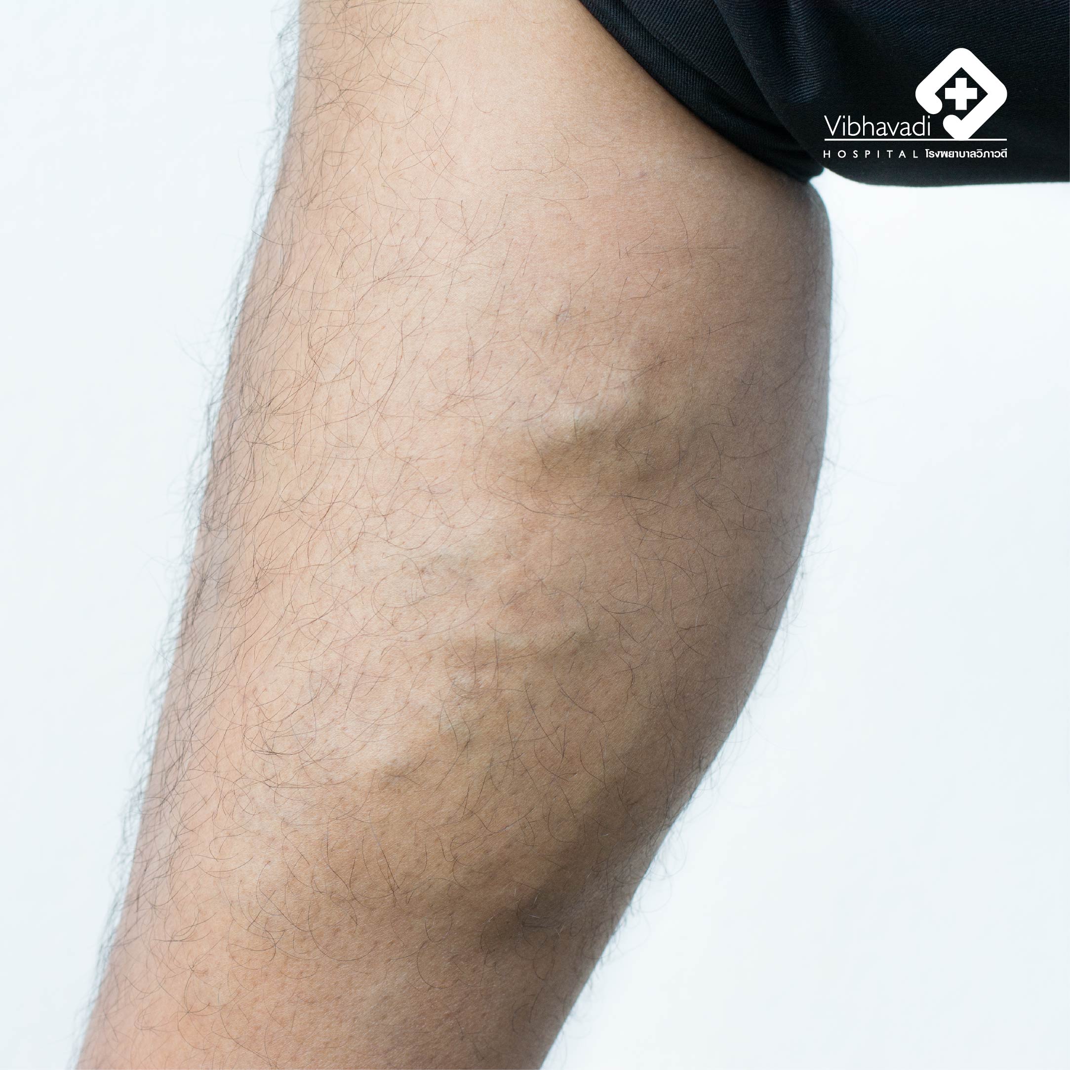 Varicose Veins