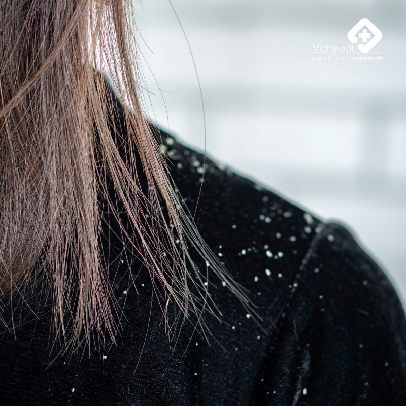 Seborrheic Dermatitis: The Condition That Arise During The Cold Season