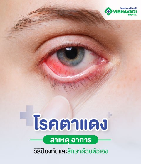 Conjunctivitis