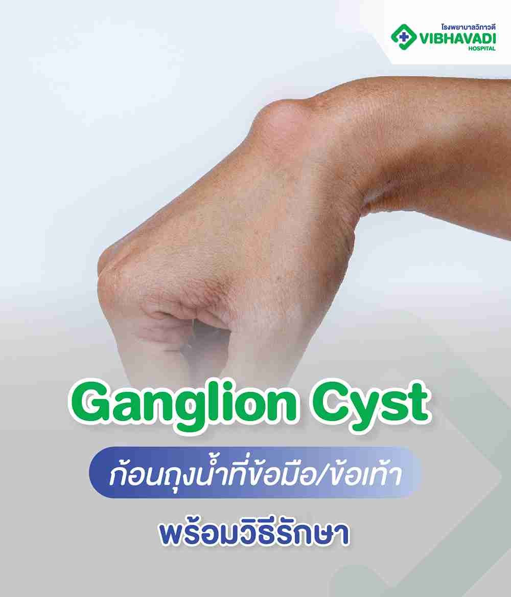 Ganglion Cyst คืออะไร รู้จักก้อนถุงน้ำที่ข้อมือและข้อเท้า