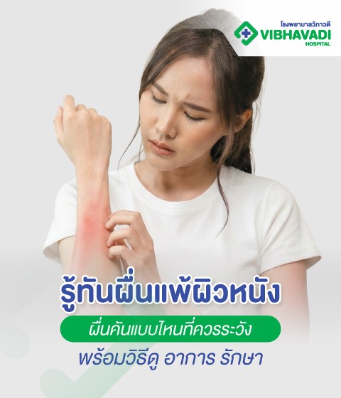 รู้ทันผื่นแพ้ผิวหนัง ผื่นคันแบบไหนที่ควรระวัง