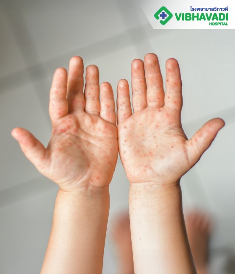 Hand, Foot and Mouth Disease (HFMD)