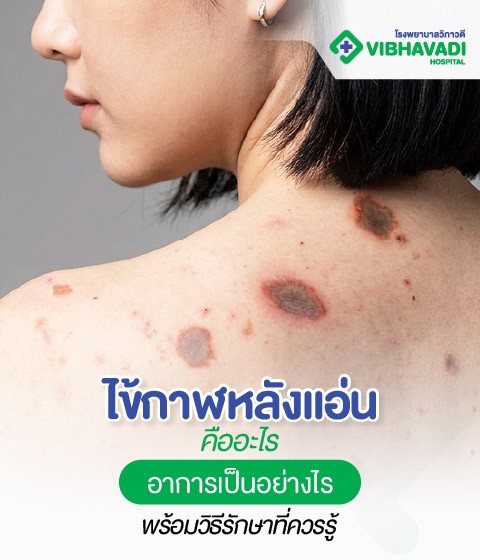 ไข้กาฬหลังแอ่นคืออะไร อาการเป็นอย่างไร พร้อมวิธีรักษาที่ควรรู้