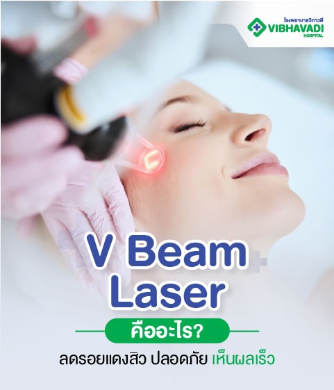 V Beam Laser