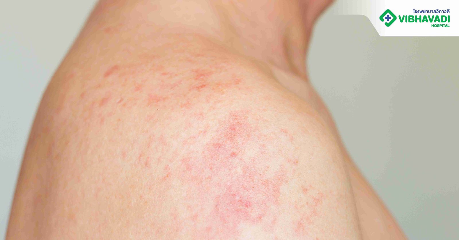 ภูมิตกหรือภาวะภูมิคุ้มกันอ่อนแอคืออะไร?