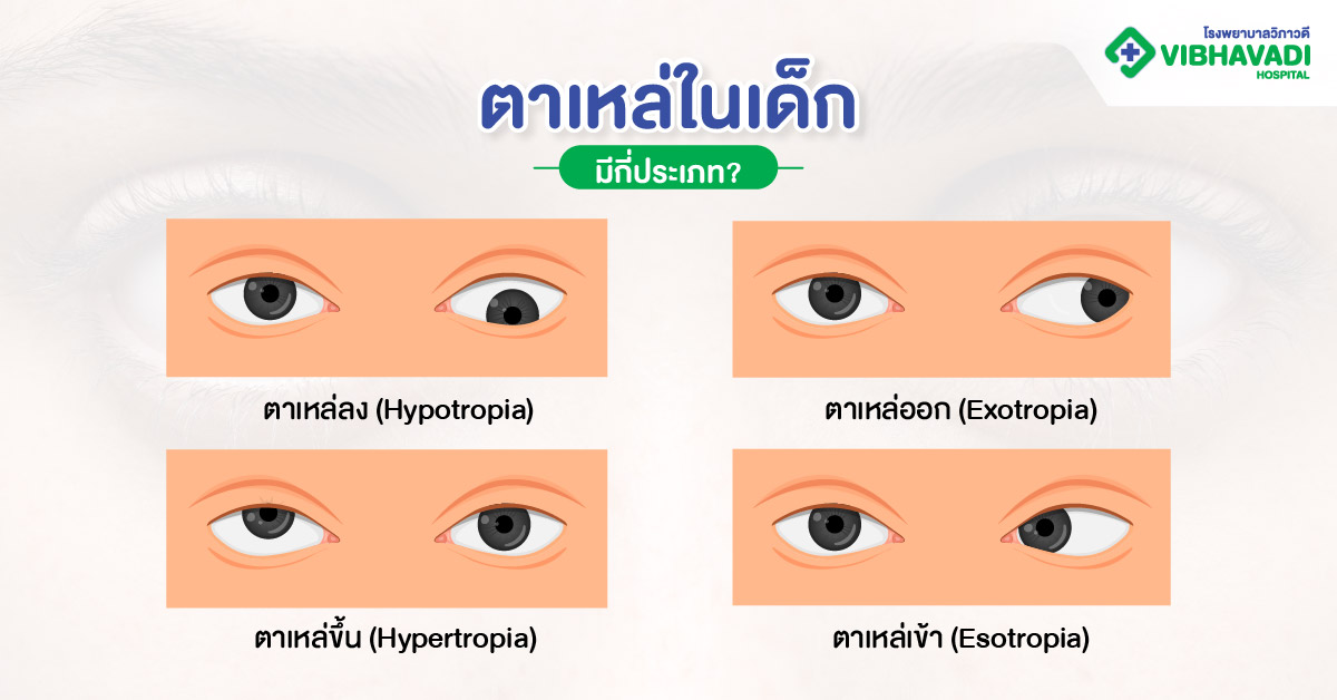 ตาเหล่ในเด็กมีกี่ประเภท?