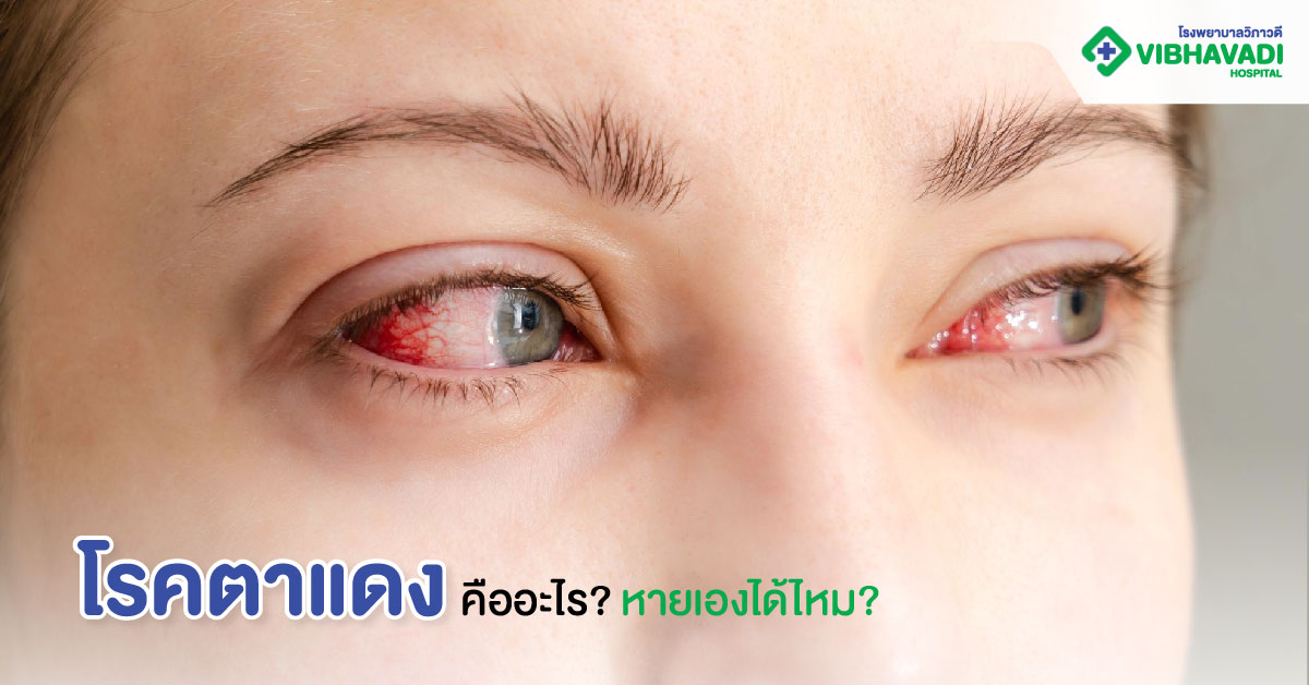 โรคตาแดงคืออะไร หายเองได้ไหม