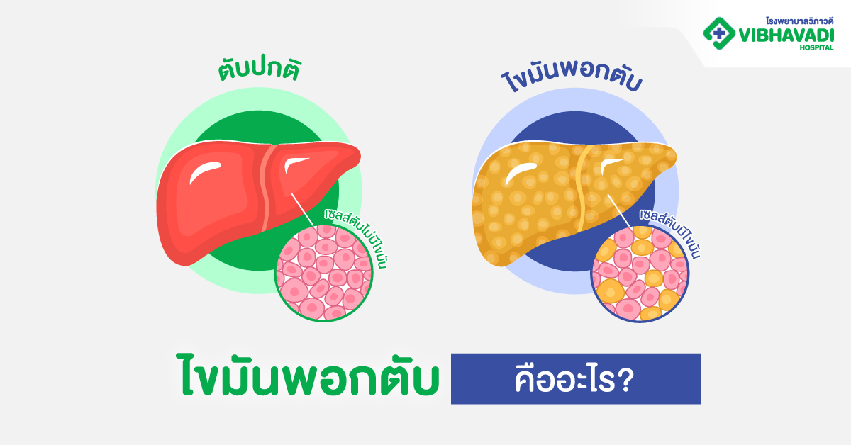 ไขมันพอกตับคืออะไร