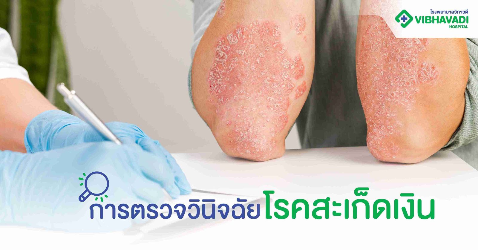 การตรวจวินิจฉัยโรคสะเก็ดเงิน