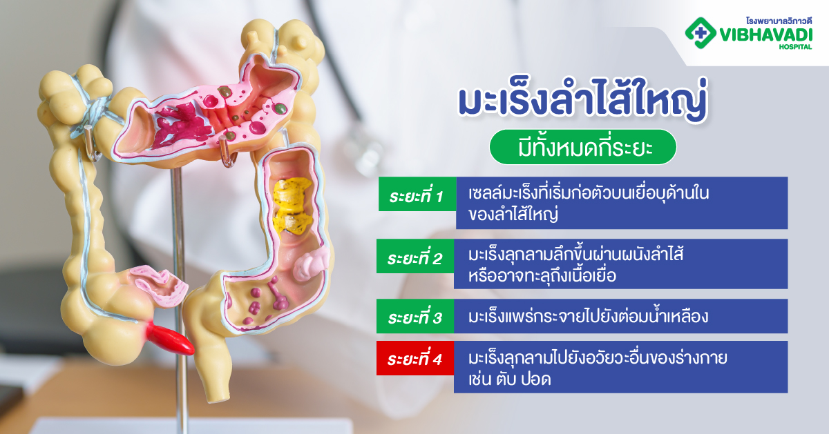 มะเร็งลำไส้ใหญ่ มีทั้งหมดกี่ระยะ