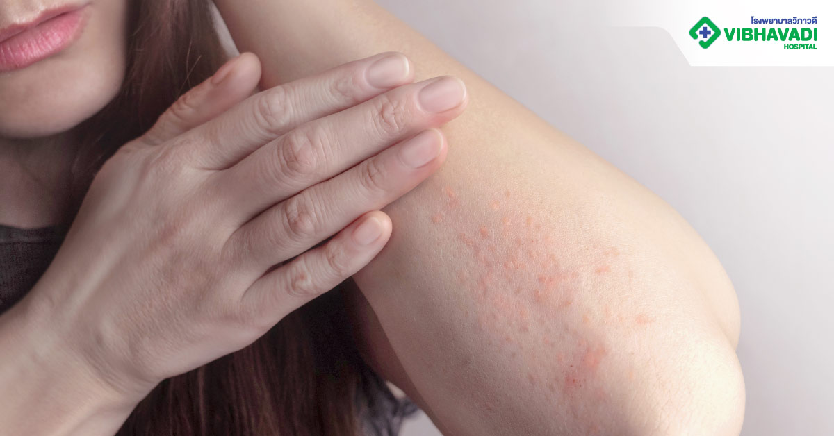 ผื่นแพ้ผิวหนังคืออะไร