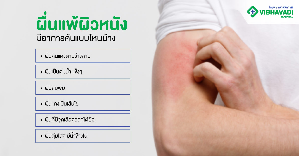 ผื่นแพ้ผิวหนัง มีอาการคันแบบไหนบ้าง