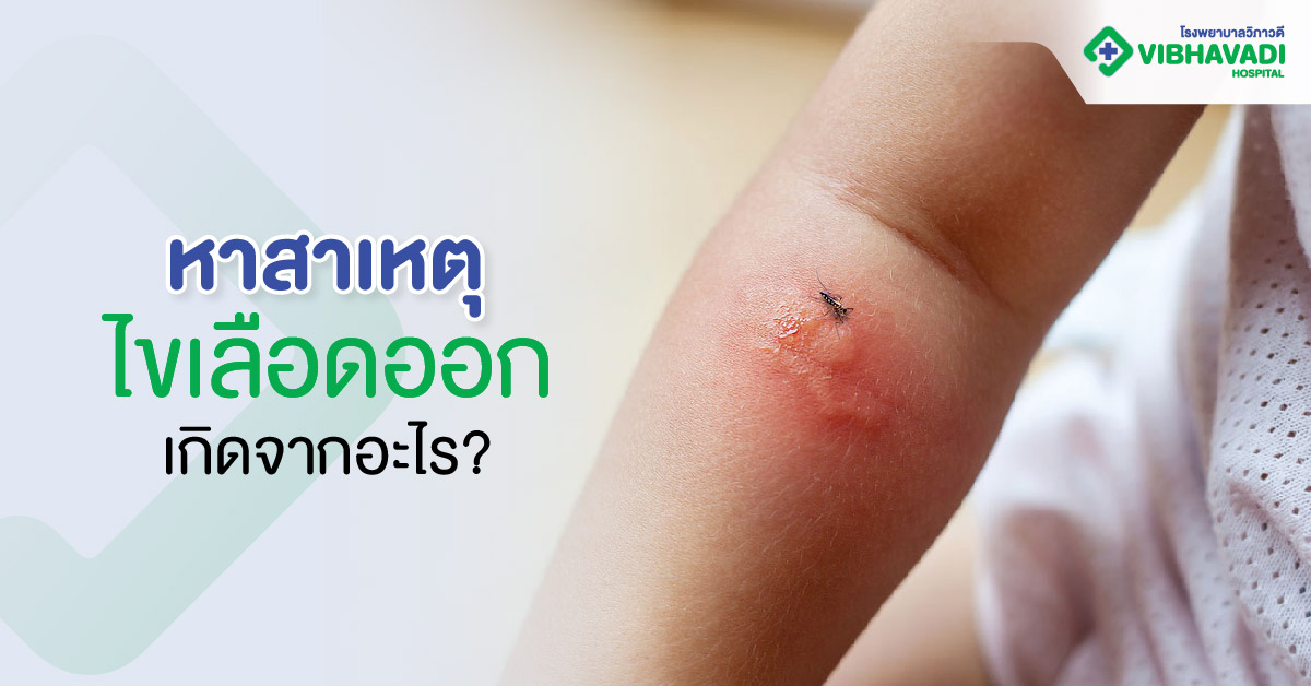 หาสาเหตุไข้เลือดออก เกิดจากอะไร