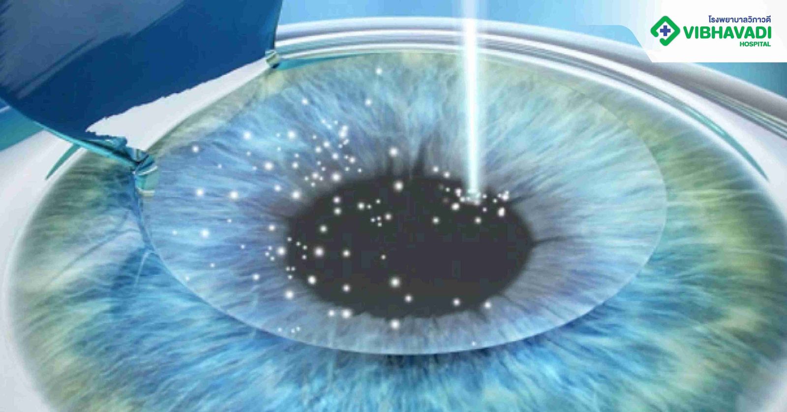  Femto LASIK คืออะไร