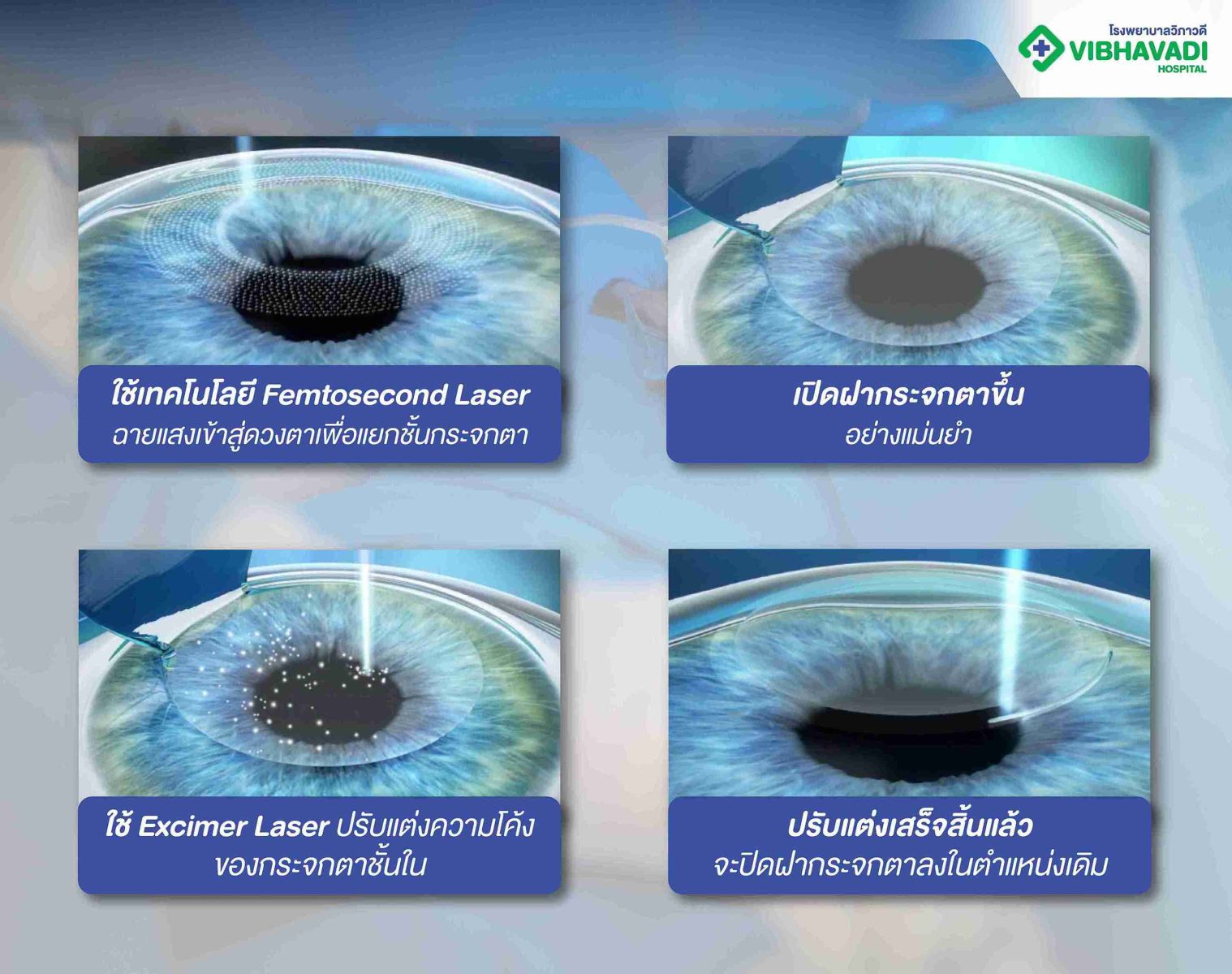 หลักการทำงานของ Femto LASIK