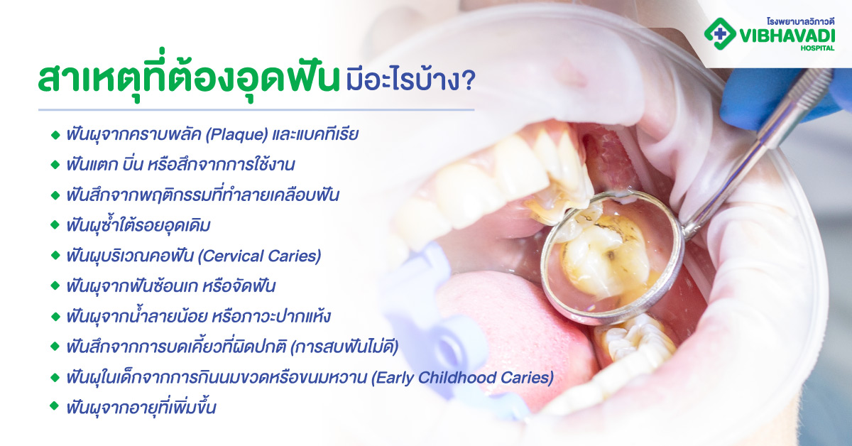 สาเหตุที่ต้องอุดฟันมีอะไรบ้าง?