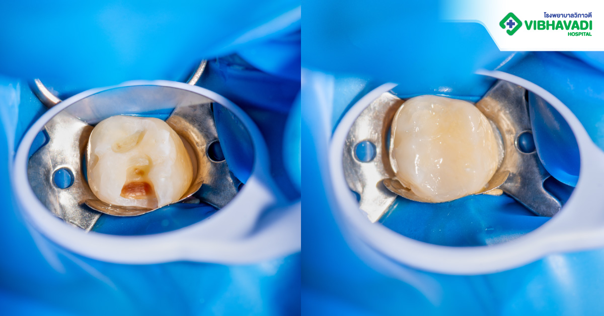 วัสดุอุดฟันมีอะไรบ้าง อุดแบบไหนดี?