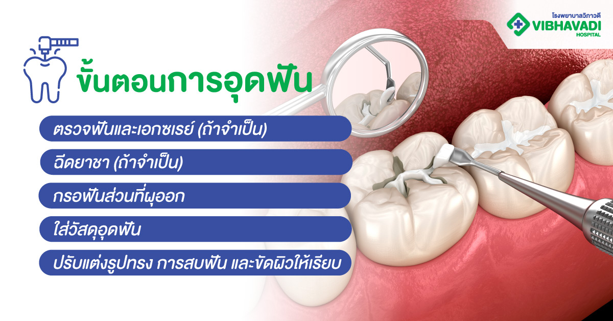 ขั้นตอนการอุดฟัน