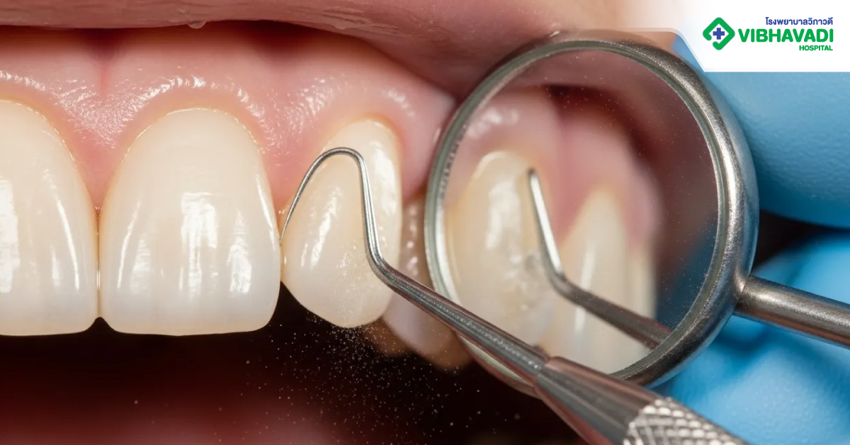 การเตรียมตัวก่อนขูดหินปูน