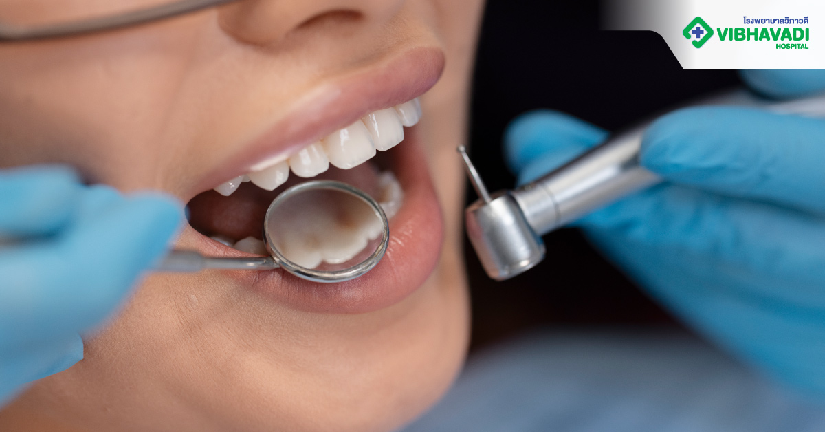 ขูดหินปูน ที่โรงพยาบาลวิภาวดี