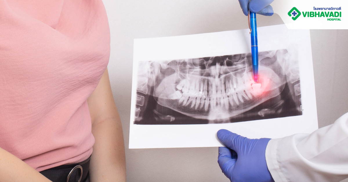 ขั้นตอนการผ่าฟันคุด