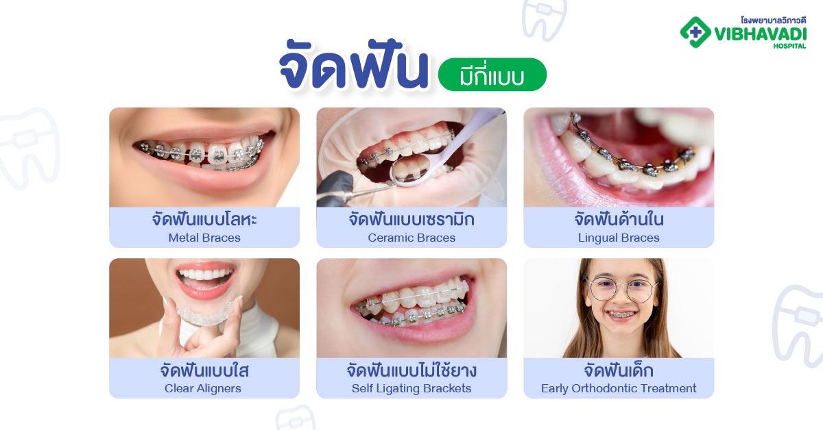 การจัดฟันมีกี่แบบ?
