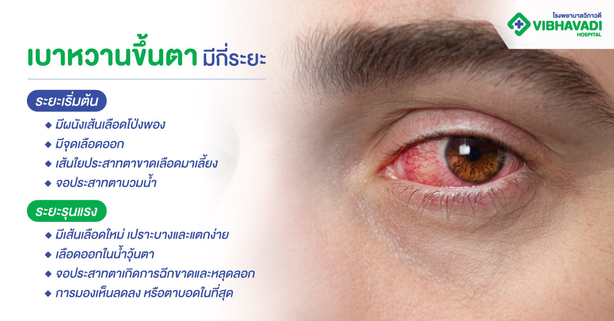 เบาหวานขึ้นตามีกี่ระยะ