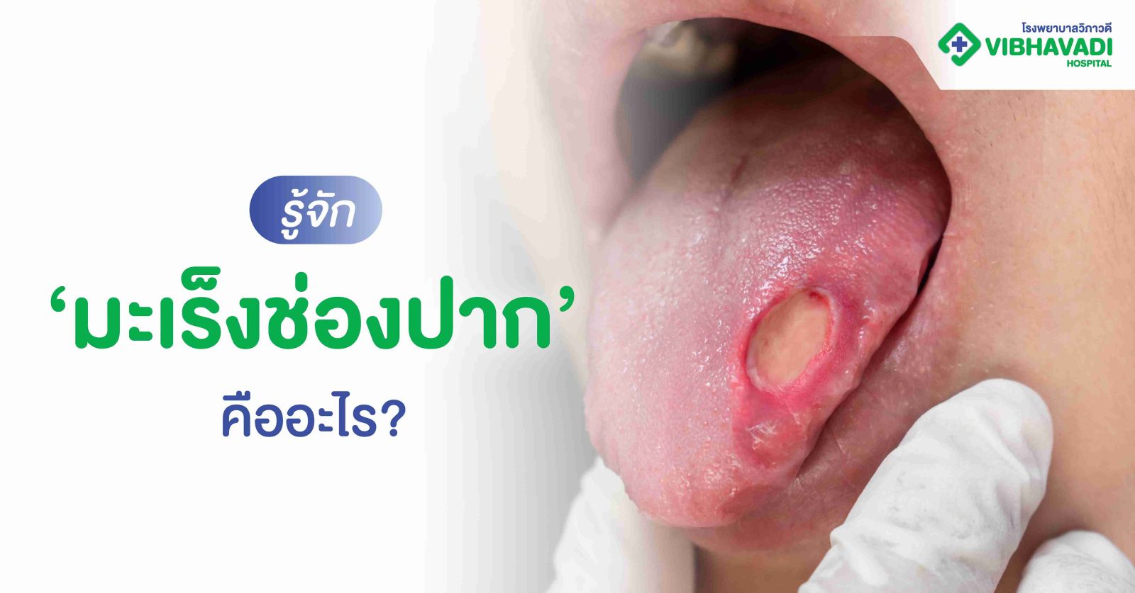 รู้จักมะเร็งช่องปาก คืออะไร?