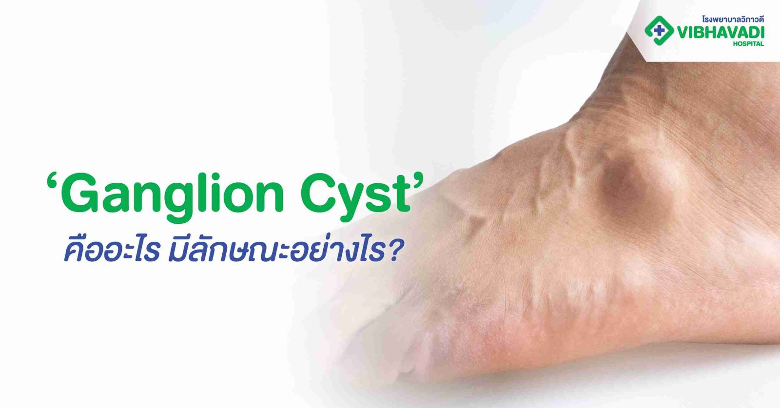 Ganglion Cyst คืออะไร มีลักษณะอย่างไร