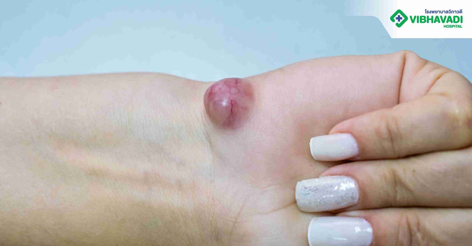 สัญญาณอาการ Ganglion Cyst ที่ควรพบแพทย์